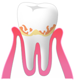 歯周病とは