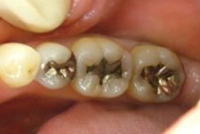 セラミックインレー（詰め物）