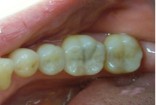 セラミックインレー 治療後