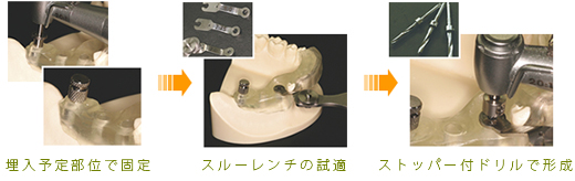 低侵襲な固定をはじめ適正化されたシステム